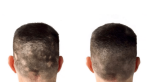 Alopecia Back of Head Image