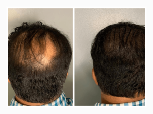 Alopecia Example Image