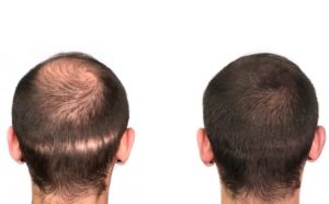 Back of the head before and after image