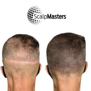 Scalp Micropigmentation Permanent