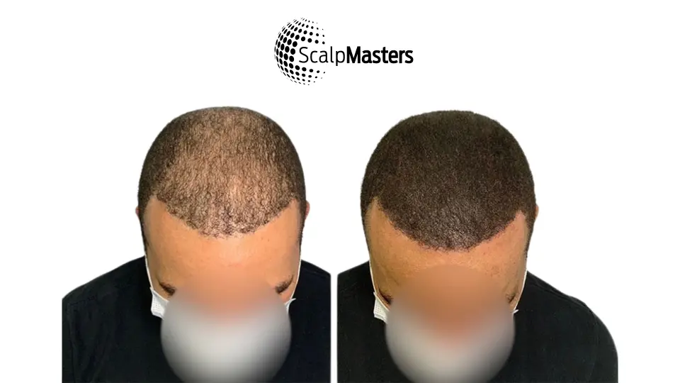 is scalp micropigmentation safe