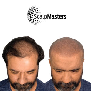 Is Scalp Micropigmentation Worth It?