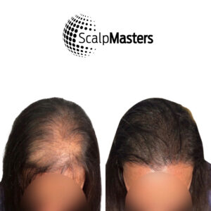 Scalp Micropigmentation With Hair Transplant