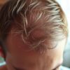 hair loss at temples