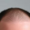 m hairline