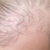 burning scalp and hair loss