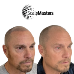 scalp micropigmentation sacramento