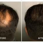 scalp micropigmentation reno